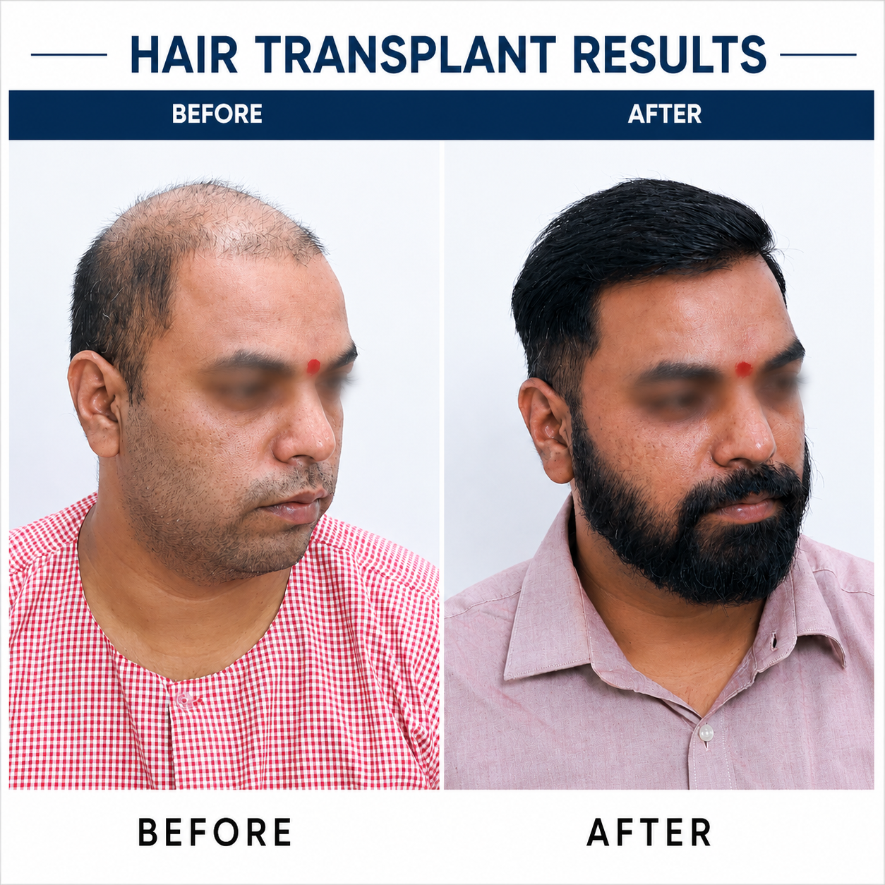 Hair Transplant Result at Dr. Amit Kerure Skin Clinic Navi Mumbai - Natural hairline, permanent results