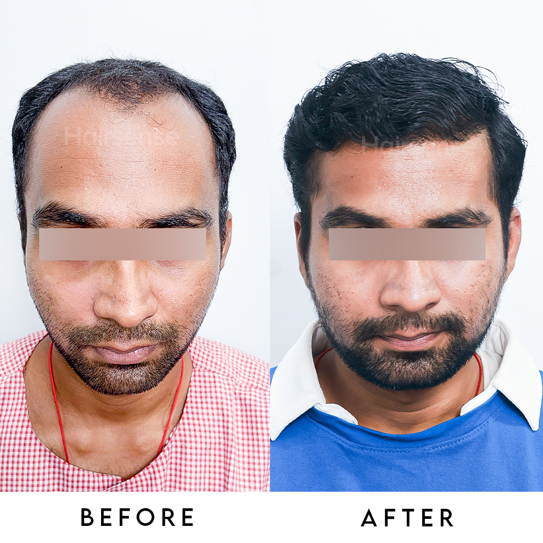 Hair transplant result 3
