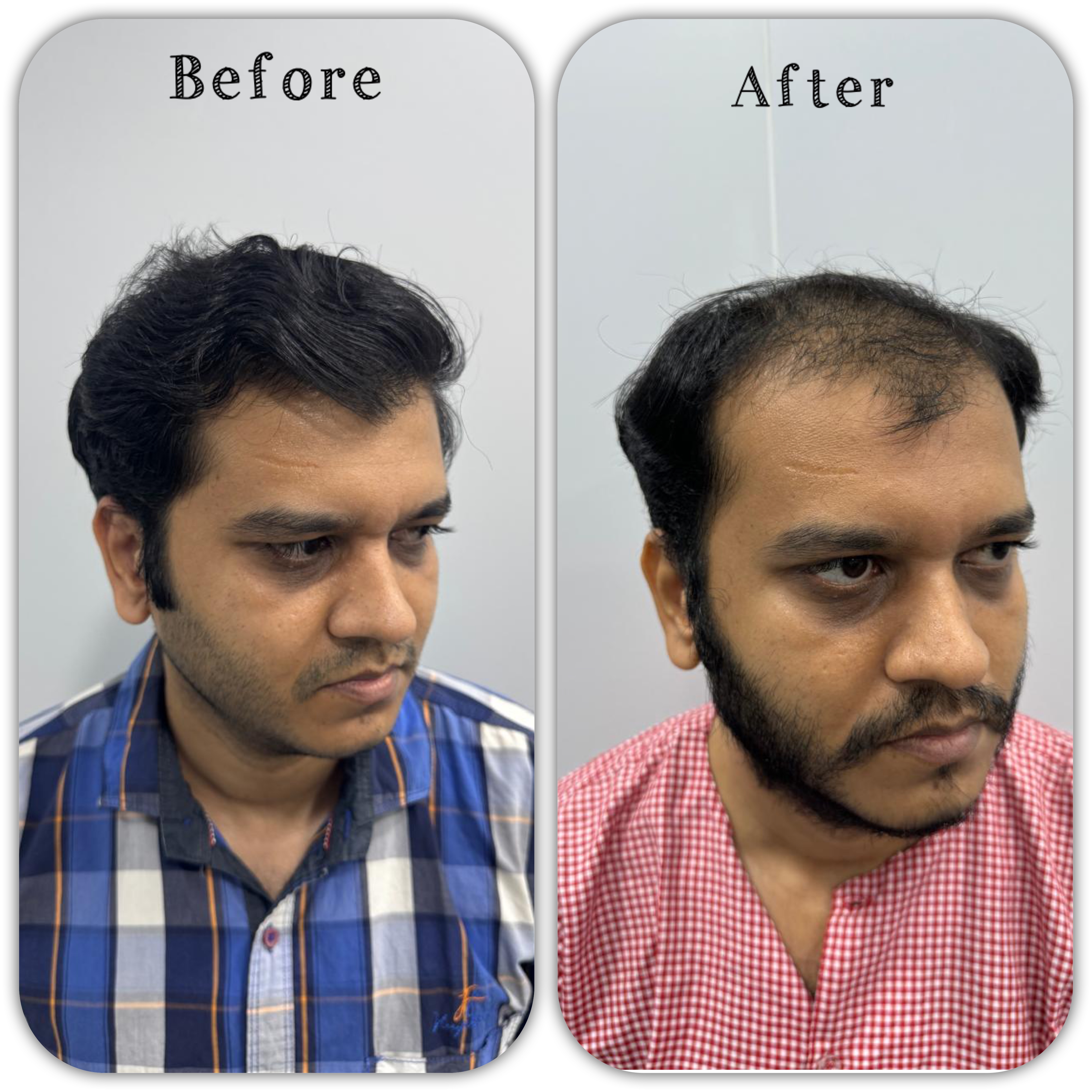 Natural hairline design hair transplant before after Mumbai